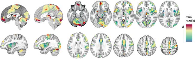 Rozdíly mezi jedinci ve zpracování bolesti v různých částech mozku (čím větší rozdíly, tím teplejší barva). Ilustrace Kohoutová L. et al., 2022